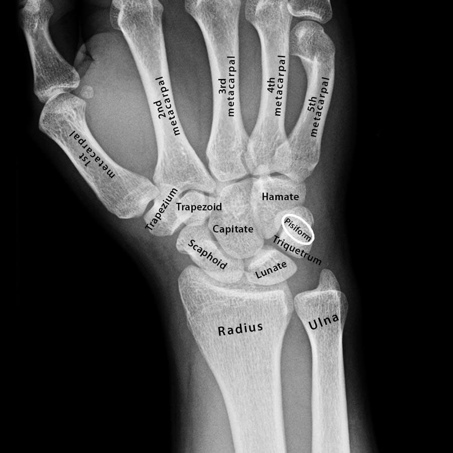 Carpal Bones Wrist Bones Definition Names Anatomy Diagram