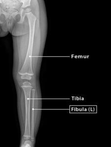 Fibula: Definition, Location, Anatomy, Functions, & Diagrams