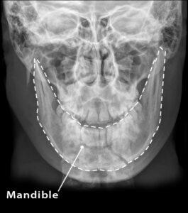 Mandible (Lower Jaw Bone) – Location, Functions, & Anatomy